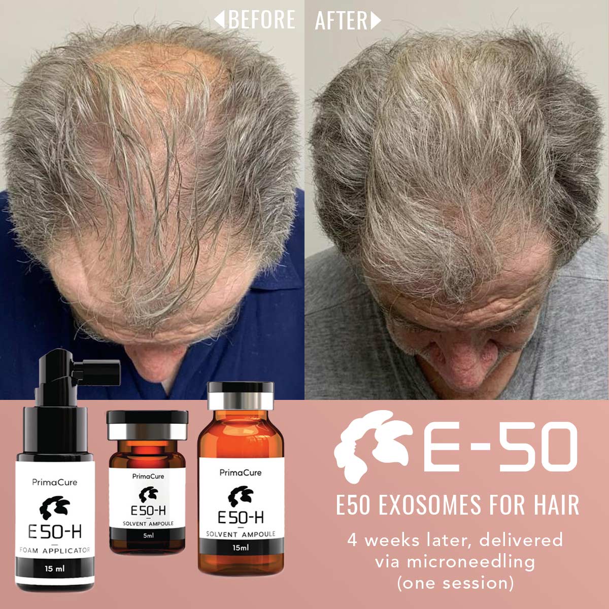 Exosome Hair Rejuvenation