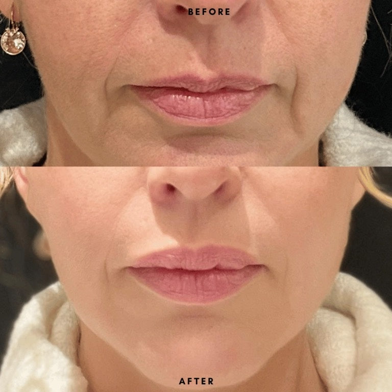 Dermal Lip Filler