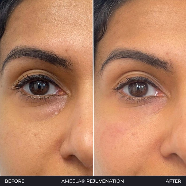 Polynucleotides (Face & Under Eyes)