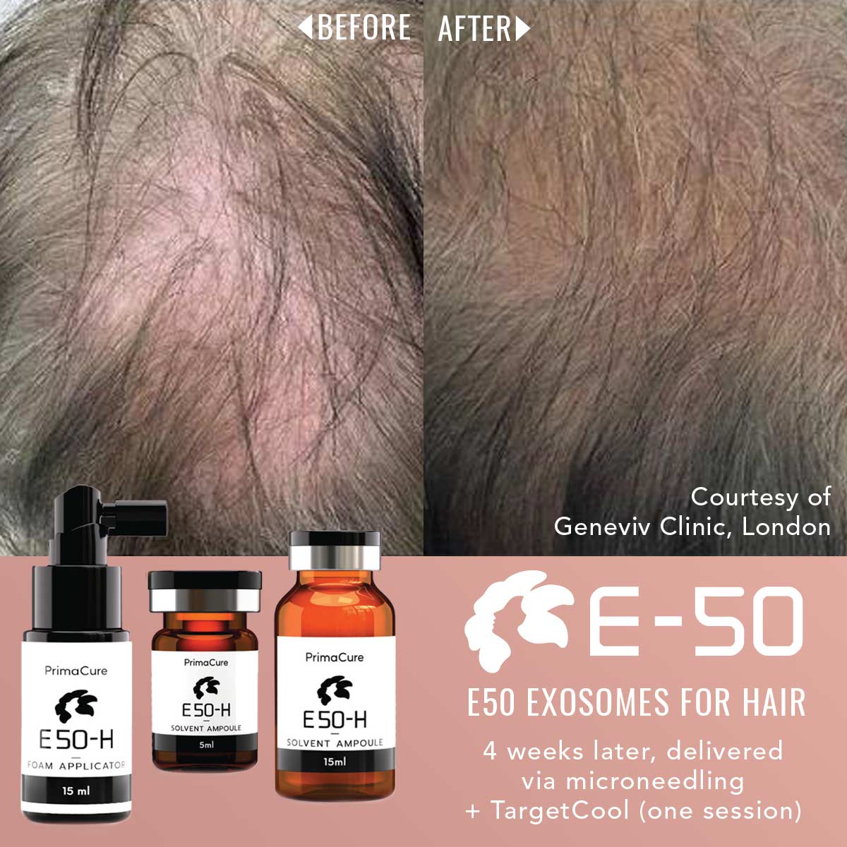 Exosome Hair Rejuvenation