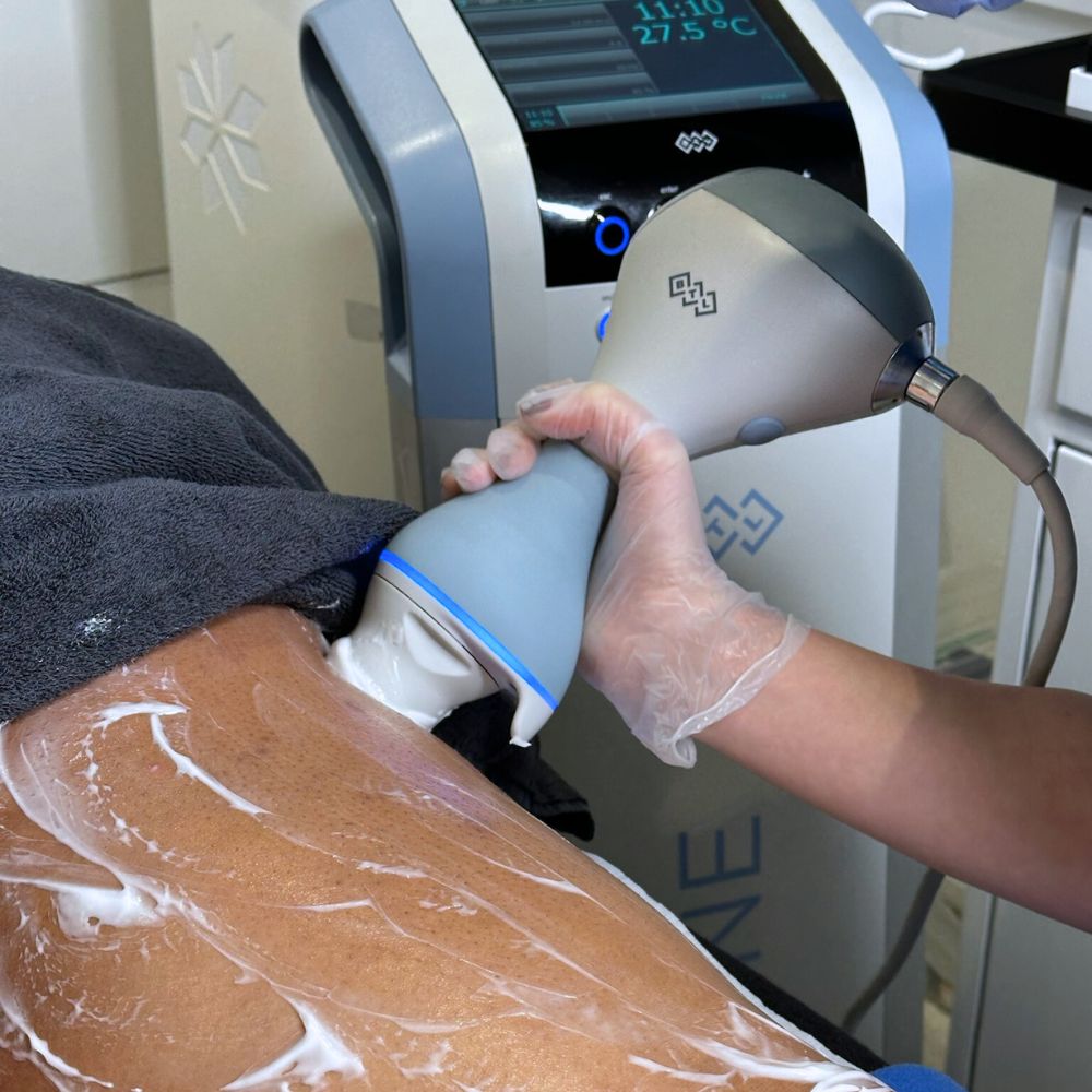 EmTone Cellulite Reduction
