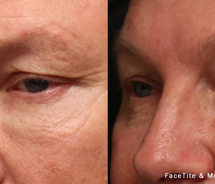 FaceTite Radiofrequency Non-Surgical Facelift