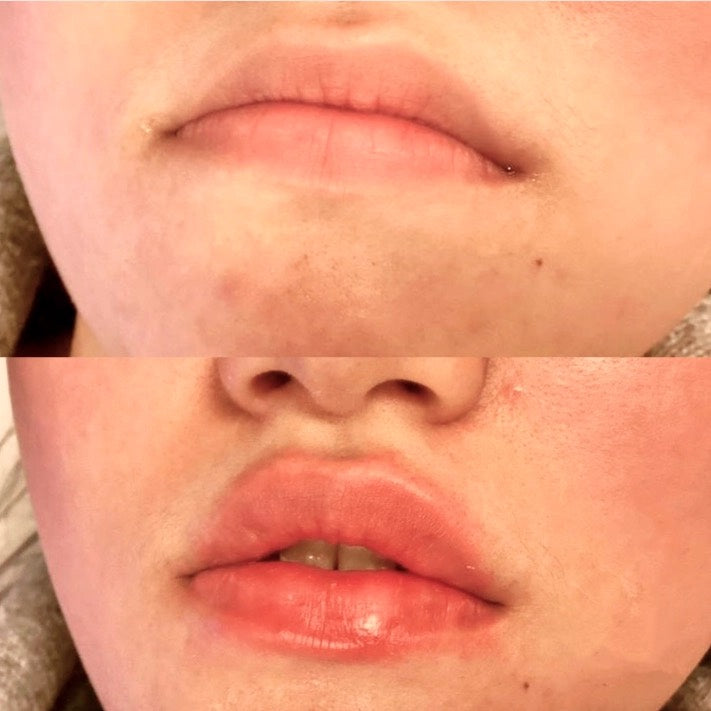 Dermal Lip Filler