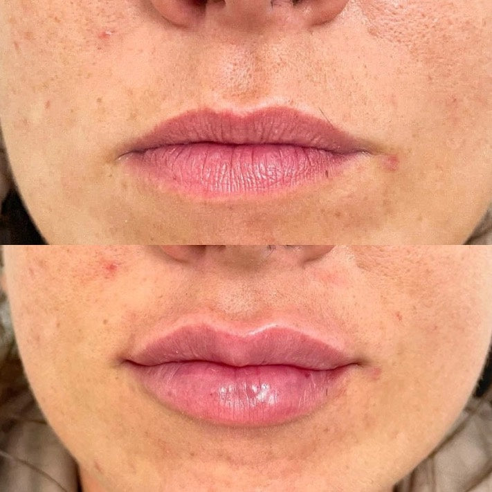 Dermal Lip Filler