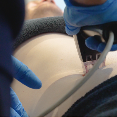 Morpheus8 Body Treatment